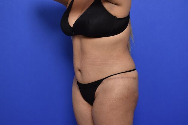 Tummy Tuck with LipoContouring: Case 25 - After