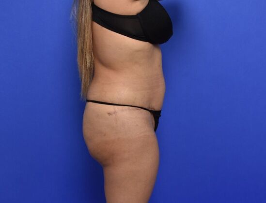 Tummy Tuck with LipoContouring: Case 25 - After