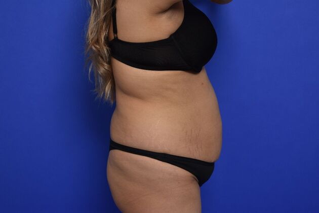 Brazilian Butt Lift: Case 9 - Before