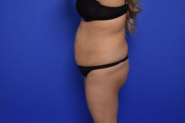 Brazilian Butt Lift: Case 9 - Before
