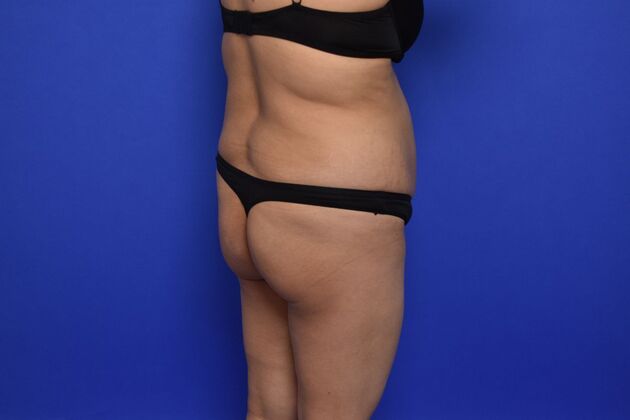 Brazilian Butt Lift: Case 9 - Before