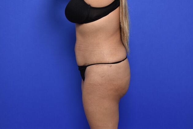 Brazilian Butt Lift: Case 9 - After