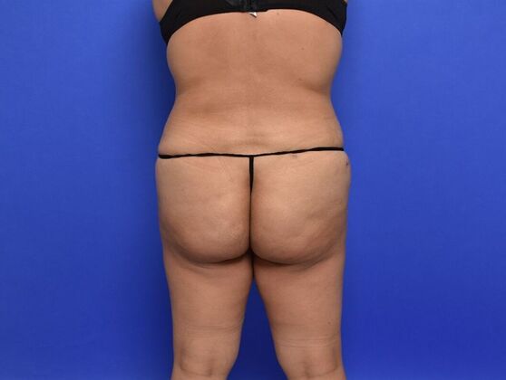 Brazilian Butt Lift Case 9 - After