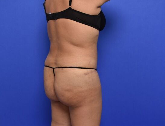 Brazilian Butt Lift: Case 9 - After