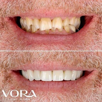 Smile Makeover Transformation Case 1 - Before