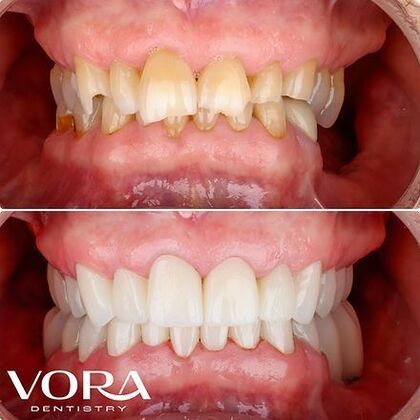 Smile Makeover Transformation Cases