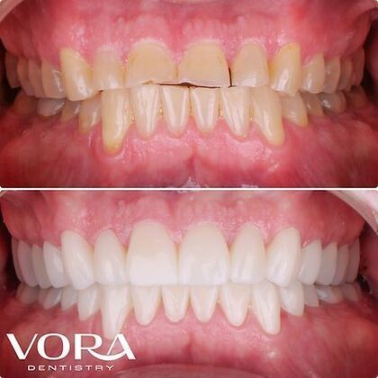 Smile Makeover Transformation Case 2 - After