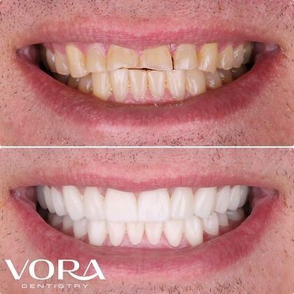 Smile Makeover Transformation Case 2 - Before