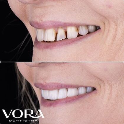 Smile Makeover Transformation Case 3