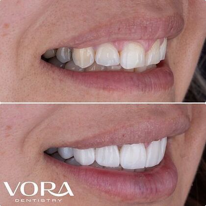 Smile Makeover Transformation Case 4