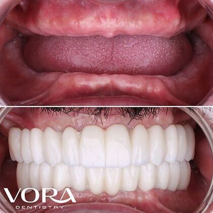All-On-4/6 Transformation Case 5