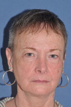 Facelift: Before and 5 years after facelift, upper and lower lids and perioral dermabrasion - Before