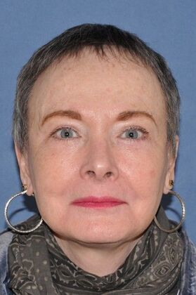 Facelift: Before and 5 years after facelift, upper and lower lids and perioral dermabrasion - After