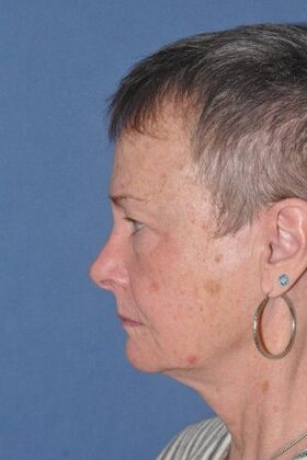 Facelift: Before and 5 years after facelift, upper and lower lids and perioral dermabrasion - Before