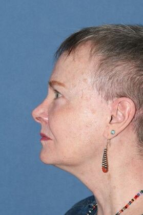Facelift: Before and 5 years after facelift, upper and lower lids and perioral dermabrasion - After