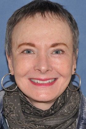 Facelift: Before and 5 years after facelift, upper and lower lids and perioral dermabrasion - After