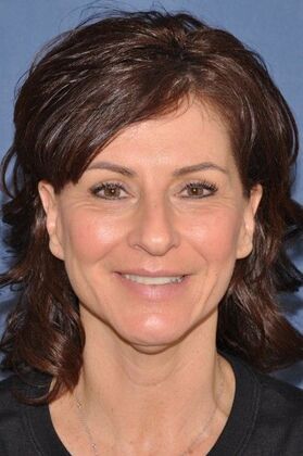 Facelift: Deep plane face and necklift - Before