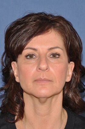 Facelift: Deep plane face and necklift - Before