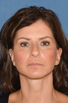 Facelift: Deep plane face and necklift - After