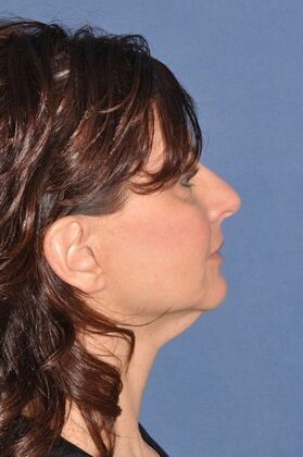 Facelift: Deep plane face and necklift - Before