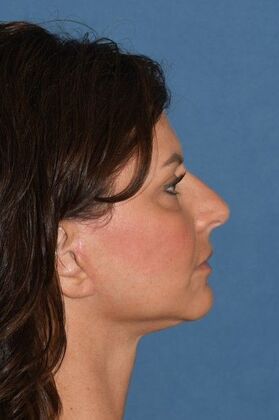 Facelift: Deep plane face and necklift - After