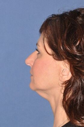 Facelift: Deep plane face and necklift - Before