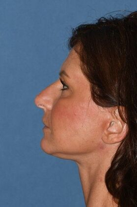 Facelift: Deep plane face and necklift - After