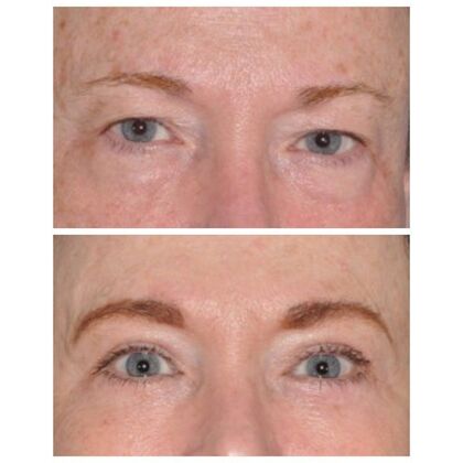 Eyelid Surgery: Before and 5 years after upper and lower lids - Before and 5 yr after