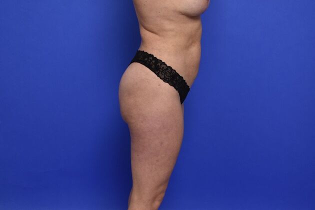 Brazilian Butt Lift (Augmentation): Case 10 - After