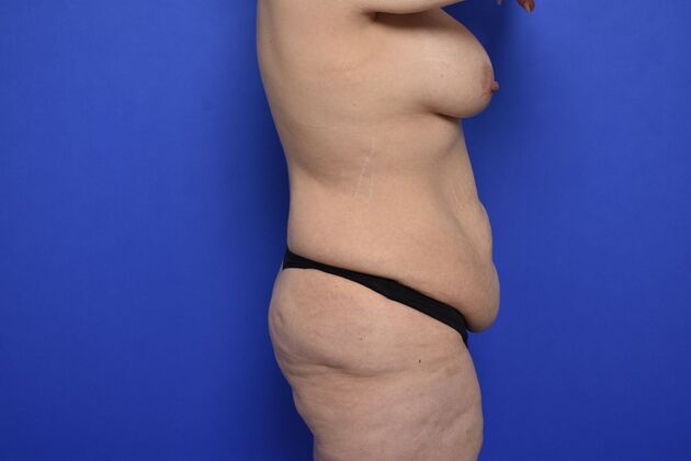 Tummy Tuck with LipoContouring: Case 27 - Before