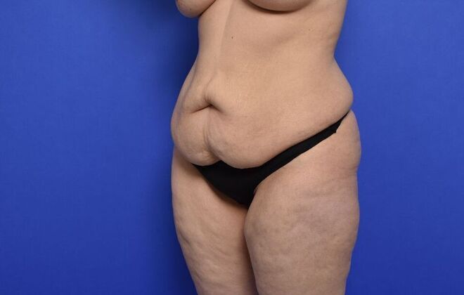 Tummy Tuck with LipoContouring: Case 27 - Before