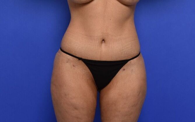 Tummy Tuck with LipoContouring: Case 27 - After
