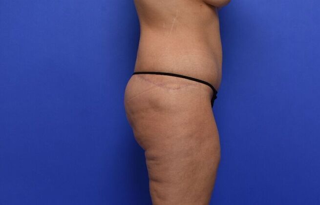 Tummy Tuck with LipoContouring: Case 27 - After