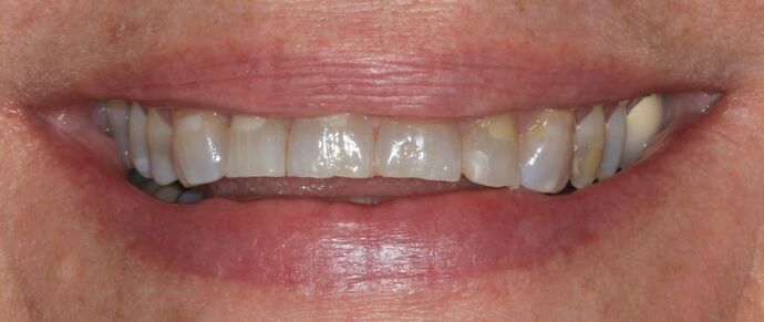 Full Mouth Reconstruction: Case 55 - Before