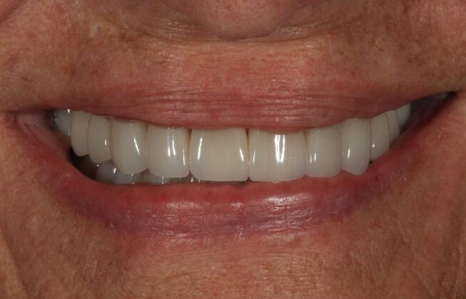 Full Mouth Reconstruction: Case 55 - After
