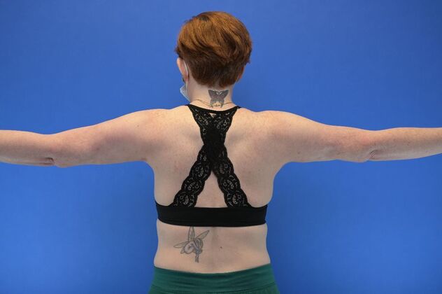 Axillary and Long-scar Brachioplasty: Case 2 - Axillary Brachioplasty - After