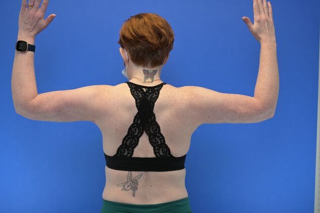 Axillary and Long-scar Brachioplasty: Case 2 - Axillary Brachioplasty - After