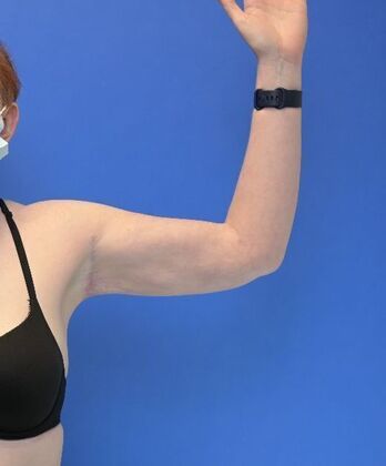 Axillary and Long-scar Brachioplasty: Case 2 - Axillary Brachioplasty - After