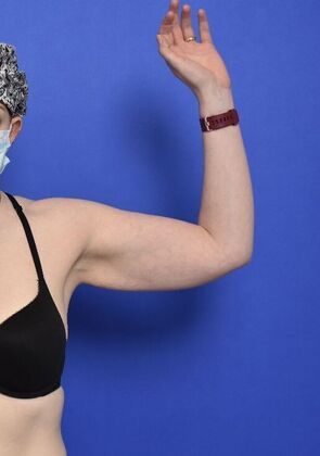 Axillary and Long-scar Brachioplasty: Case 2 - Axillary Brachioplasty - Before
