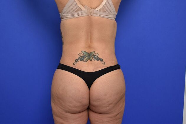 Brazilian Butt Lift (Augmentation): Case 11 - After