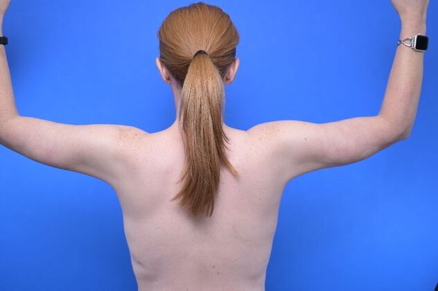Axillary and Long-scar Brachioplasty Case 3 - After
