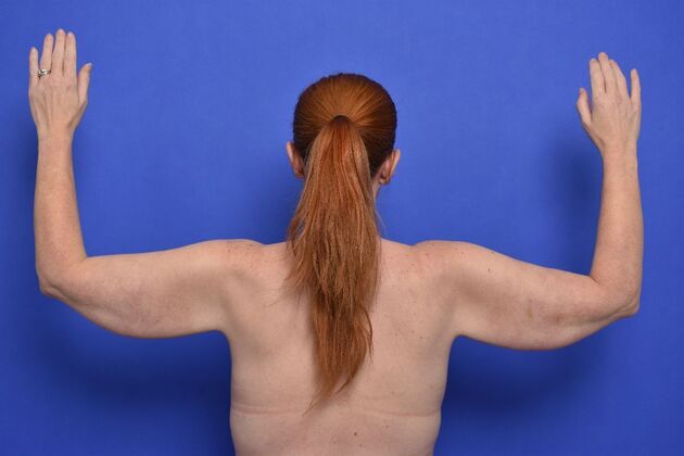 Axillary and Long-scar Brachioplasty Case 3 - Before