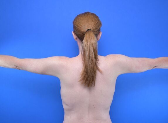 Axillary and Long-scar Brachioplasty: Case 3 - After