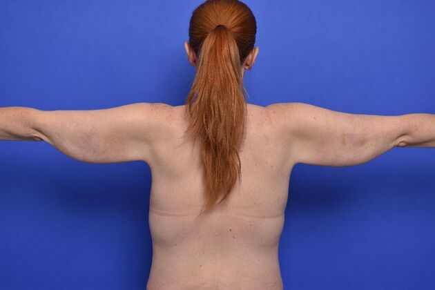Axillary and Long-scar Brachioplasty: Case 3 - Before