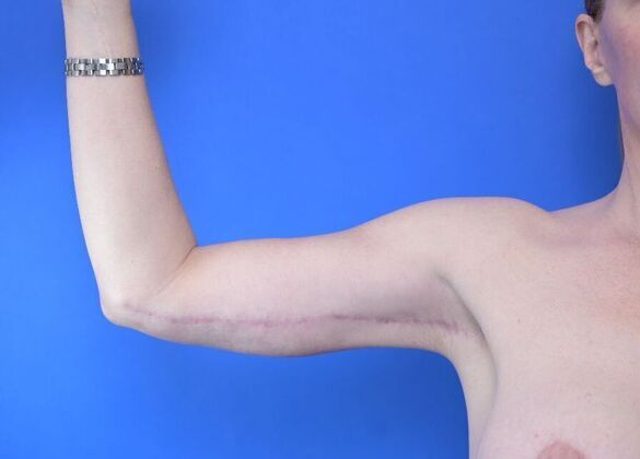 Axillary and Long-scar Brachioplasty: Case 3 - After