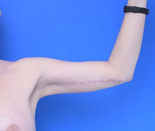Axillary and Long-scar Brachioplasty: Case 3 - After