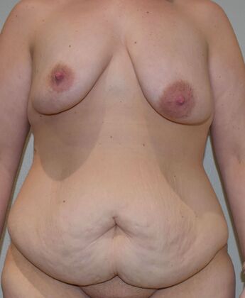 Massive Weight Loss  Case 17 - Before