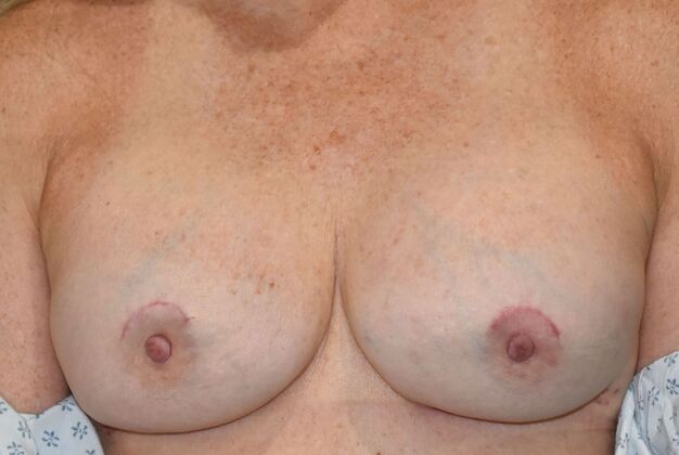 Breast Revision: Case 365 - After