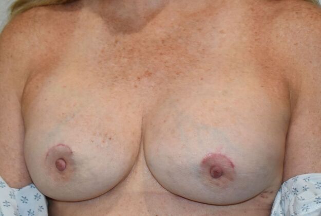 Breast Revision: Case 365 - After
