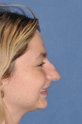 Rhinoplasty Transformative rhinoplasty at 2 years - Before